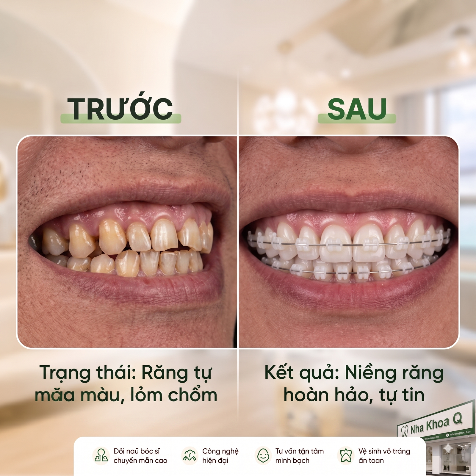 Niềng răng