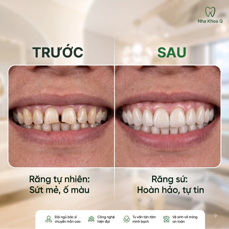 Răng sứ